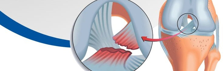 Bounce Back Stronger: A Comprehensive Guide to ACL Recovery with Kinetix