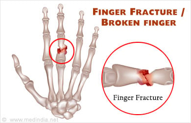 Finger bone injury